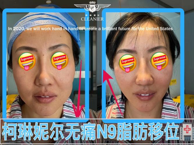 剖腹产后大便肚子疼 剖腹产后大便肚子疼