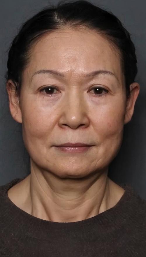 有脓痤疮可以用火针治疗吗 有脓痤疮可以用火针治疗吗